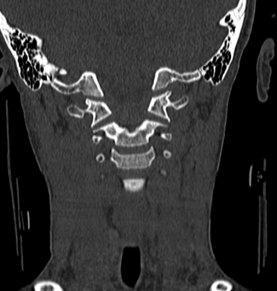 File:Normal CT cervical spine - 12-year-old (Radiopaedia 55352-61775 Coronal bone window 79).jpg