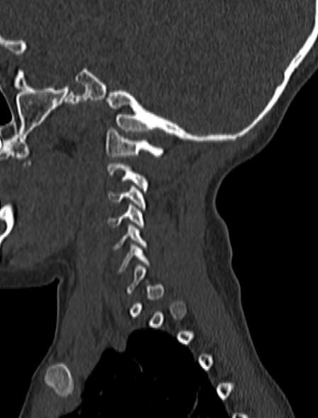 Normal CT cervical spine - pediatric (Radiopaedia 52549-58462 Sagittal bone window 179).jpg