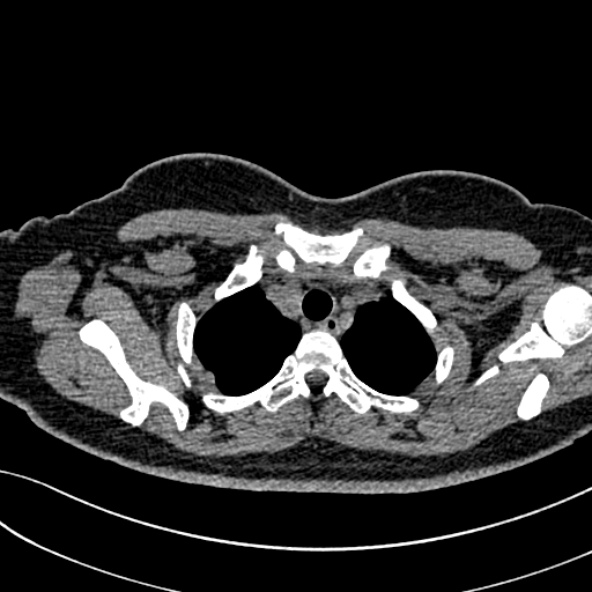 Normal CT chest- adult female (Radiopaedia 52522-58428 Axial non-contrast 23).jpg