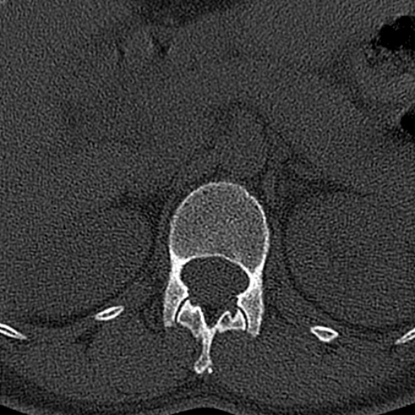 File:Normal CT lumbar spine (Radiopaedia 53981-60118 Axial bone window 9).jpg
