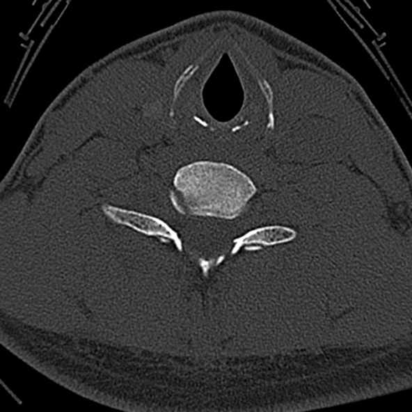 Normal CT of the cervical spine (Radiopaedia 53322-59305 Axial bone window 193).jpg