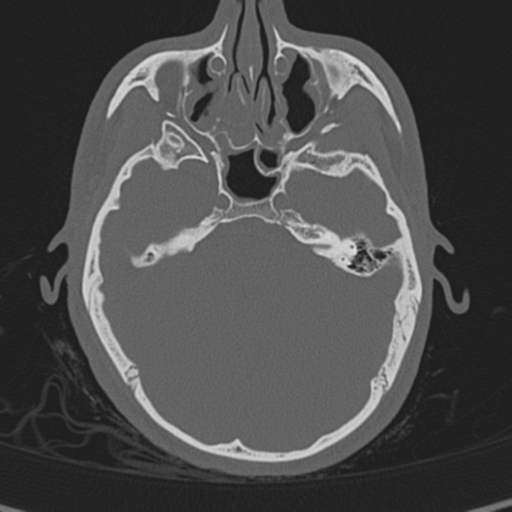 Normal CT skull (Radiopaedia 40798-43459 A 47).png