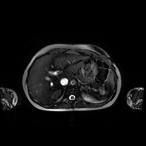 File:Normal MRI abdomen in pregnancy (Radiopaedia 88001-104541 Axial Gradient Echo 11).jpg