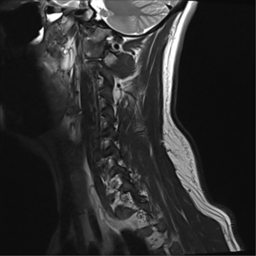 File:Normal MRI cervical spine (infection protocol) (Radiopaedia 53916-60039 Sagittal T2 3).png