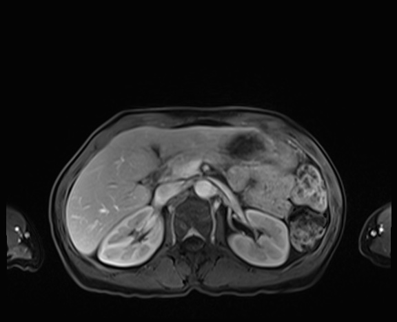 Normal adrenal glands MRI (Radiopaedia 82017-96004 K 33).jpg