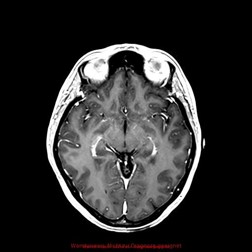Normal adult brain MRI (non-enhanced and contrast-enhanced) (Radiopaedia 75262-86379 Axial T1 C+ 97).jpg