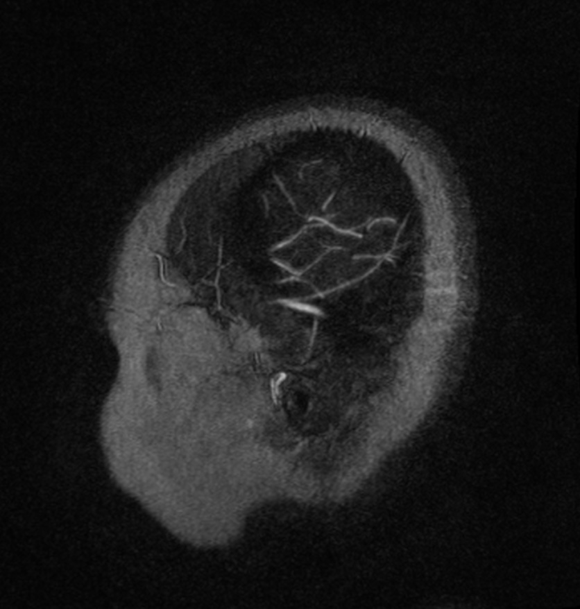 Normal brain MRI and venogram (Radiopaedia 39554-41862 Sagittal MRV 64).jpg
