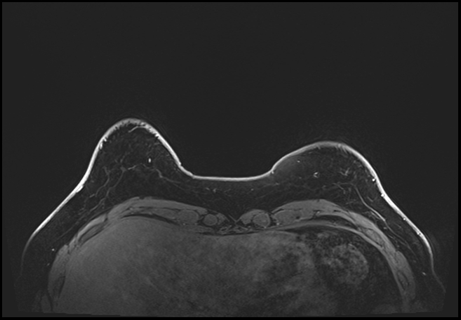 Normal breast MRI - dense breasts (Radiopaedia 80454-93850 C 31).jpg
