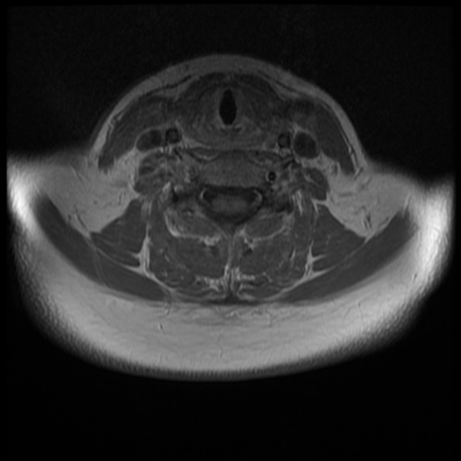 File:Normal cervical and thoracic spine MRI (Radiopaedia 35630-37156 Axial T1 C+ 15).png