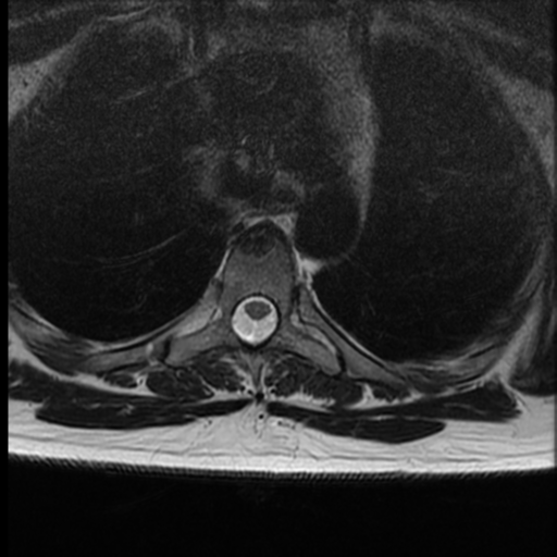 File:Normal cervical and thoracic spine MRI (Radiopaedia 35630-37156 H 32).png
