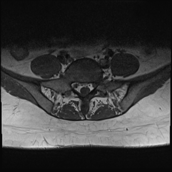 File:Normal lumbar spine MRI- 3 T (Radiopaedia 53280-59250 Axial 29).jpg
