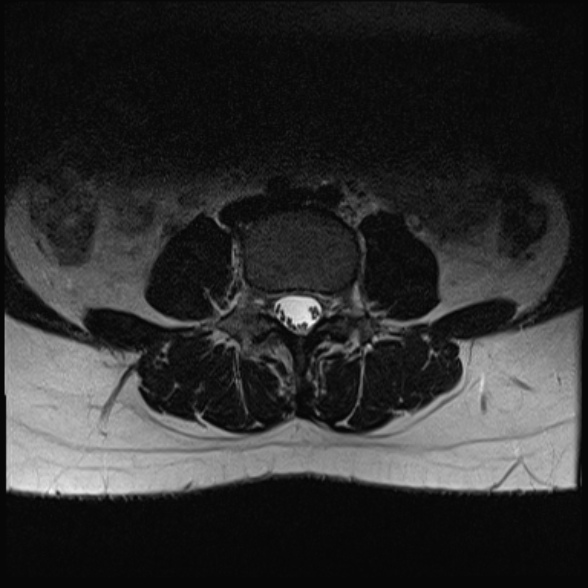 File:Normal lumbar spine MRI- 3 T (Radiopaedia 53280-59250 Axial T2 14).jpg