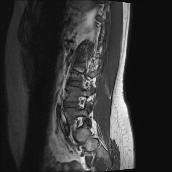 File:Normal lumbar spine MRI- 3 T (Radiopaedia 53280-59250 Sagittal T1 19).jpg