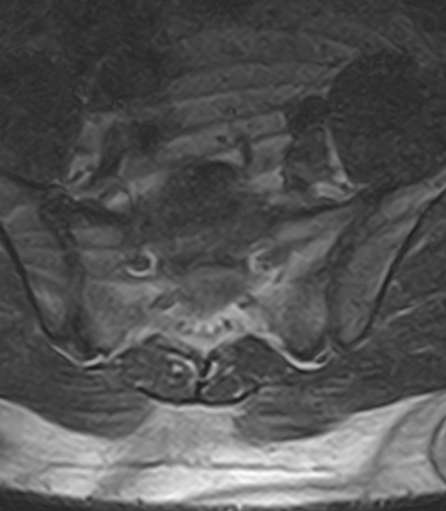 Normal lumbar spine MRI - low-field MRI scanner (Radiopaedia 40976-43699 Axial T2 97).jpg