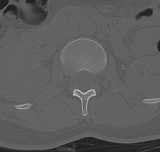 File:Normal lumbosacral CT (Radiopaedia 37923-39867 Axial bone window 36).png