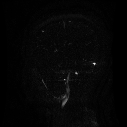 Normal noncontrast MR venography (Radiopaedia 87578-103957 A 132).jpg