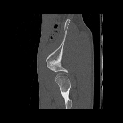 Normal pelvis (Radiopaedia 51473-57238 Sagittal bone window 27).jpg