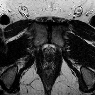 File:Normal prostate (MRI) (Radiopaedia 29986-30535 Axial T2 2).jpg