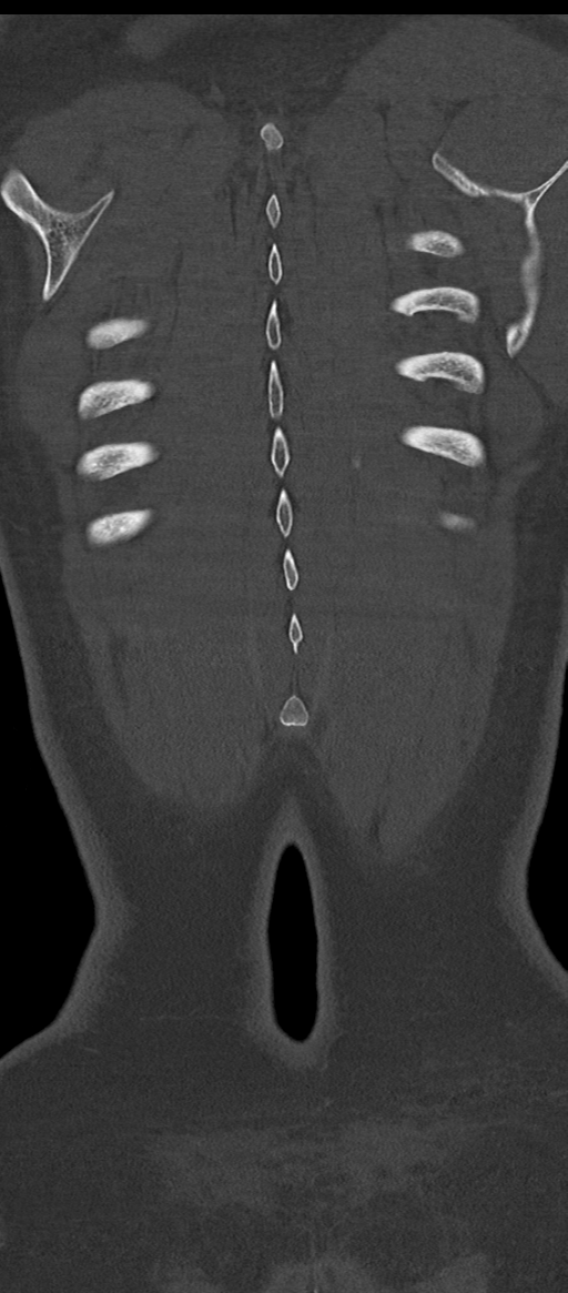 Normal thoracolumbar spine (Radiopaedia 43822-47309 Coronal bone window 85).png