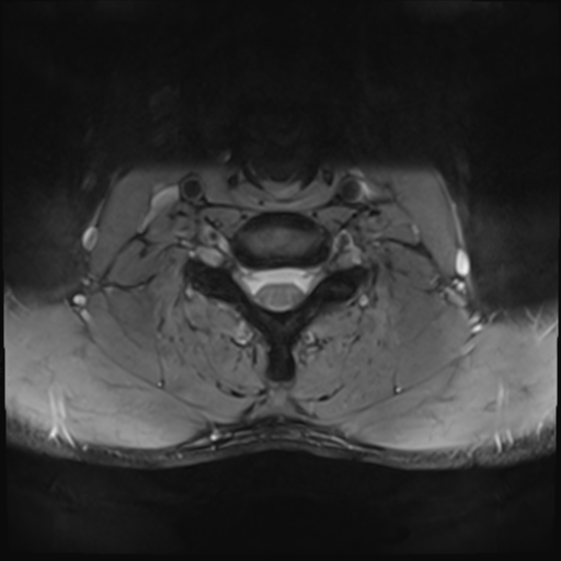 File:Normal trauma cervical spine (Radiopaedia 41017-43762 Axial T2 21).png