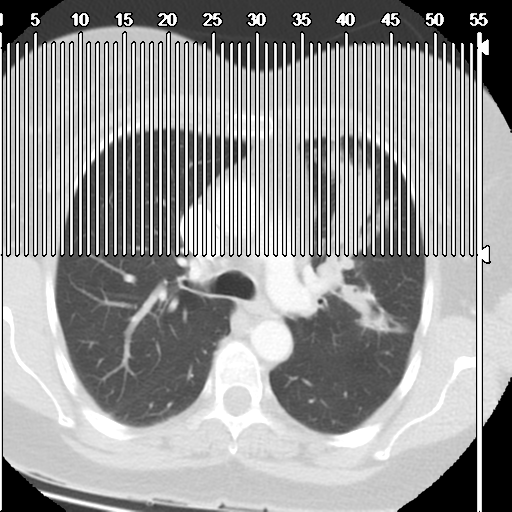 Obstructing typical carcinoid causing bronchoceles (Radiopaedia 50149-55476 Sagittal lung window 1).png