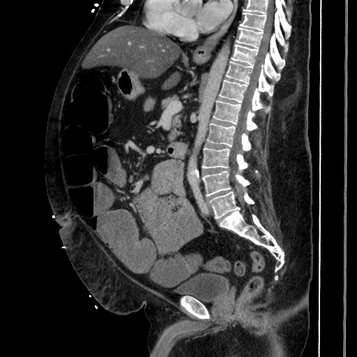 Obstructive colonic diverticular stricture (Radiopaedia 81085-94675 C 127).jpg