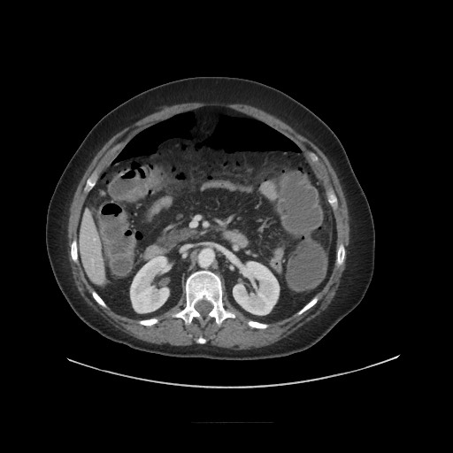 Obstructive distal colonic adenocarcinoma causing cecal perforation (Radiopaedia 86830-102989 A 80).jpg