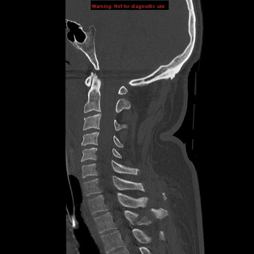 File:Occipital condyle fracture (Radiopaedia 18366-18208 Sagittal bone window 17).jpg