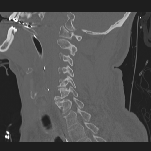 File:Occipital condyle fracture (Radiopaedia 33467-34517 Sagittal bone window 45).png