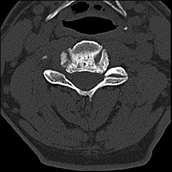 Occipital condyle fracture (type 1) (Radiopaedia 87670-104084 Axial bone window 43).jpg