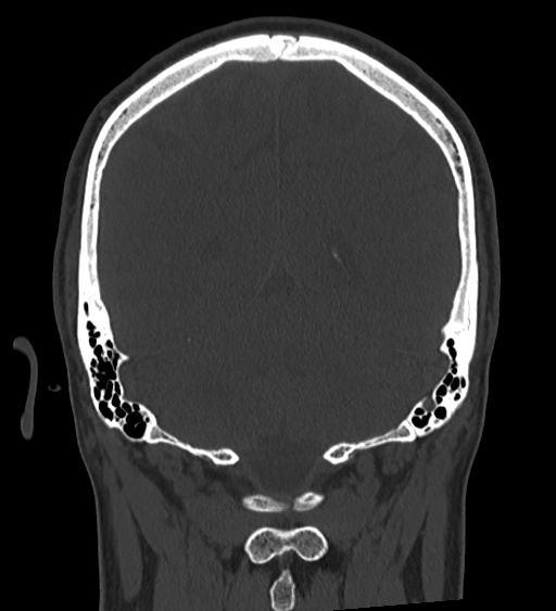 Occipital spur and Currarino type A atlas anomaly (Radiopaedia 87027-103285 Coronal bone window 106).jpg