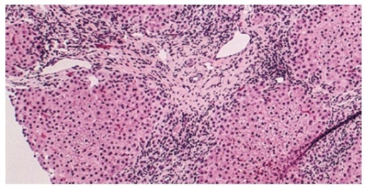 Histology of primary biliary cholangitis × 200 liver biopsy