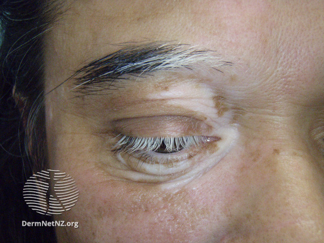 File:Segmental vitiligo (DermNet NZ colour-vitiligo-55).jpg