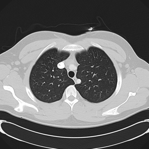 File:'Bovine' aortic arch (Radiopaedia 33554-34637 Axial lung window 15).png