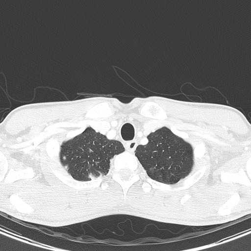 AIDS-related Kaposi sarcoma (Radiopaedia 85247-100811 Axial lung window 16).jpg