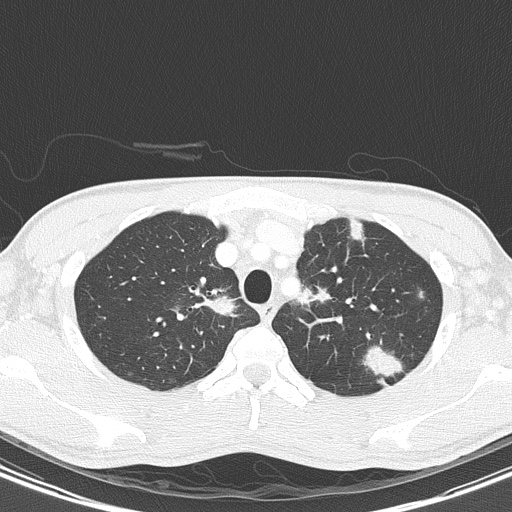 File:AIDS-related Kaposi sarcoma (Radiopaedia 85247-100811 Axial lung window 35).jpg
