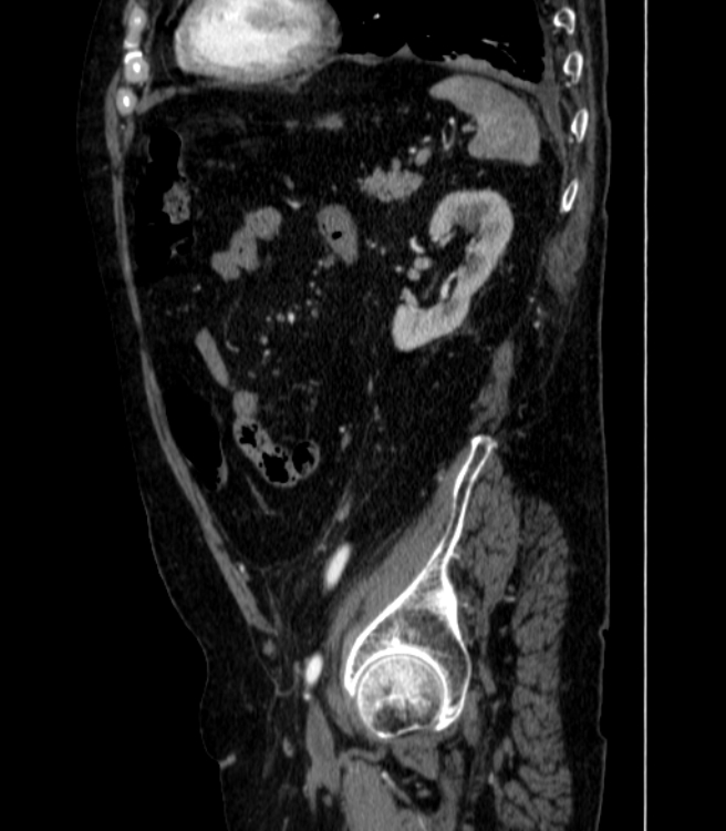 Abdominal aortic aneurysm (Radiopaedia 25855-26001 Sagittal C+ arterial phase 58).jpg