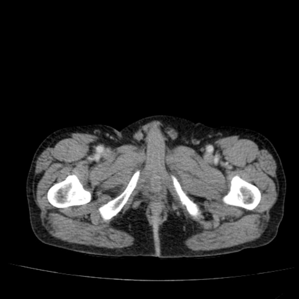 Abdominal aortic aneurysm (Radiopaedia 29248-29660 Axial C+ portal venous phase 69).jpg