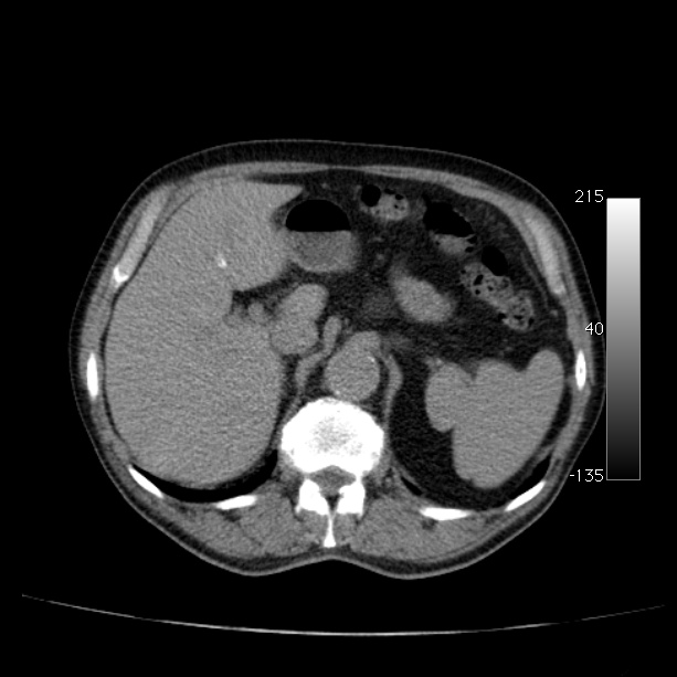 Abdominal aortic aneurysm (Radiopaedia 29248-29660 Axial non-contrast 16).jpg
