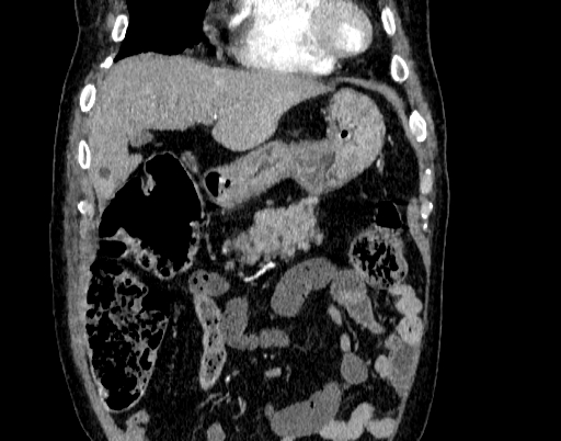 Abdominal aortic aneurysm (Radiopaedia 67117-76452 Coronal C+ arterial phase 12).jpg