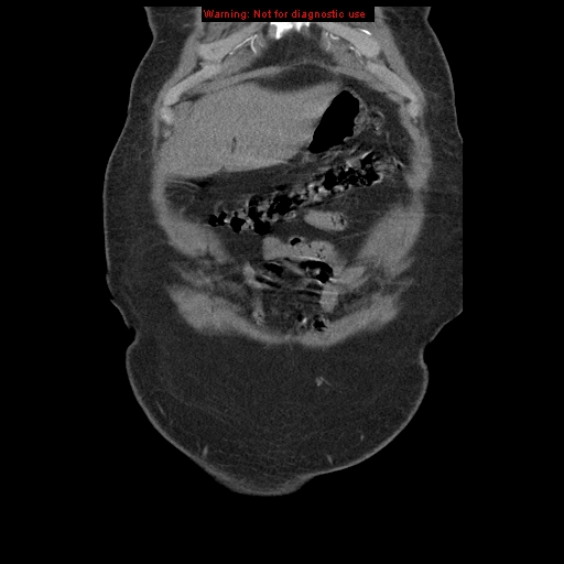 File:Abdominal aortic aneurysm (Radiopaedia 8190-9038 Coronal C+ arterial phase 17).jpg