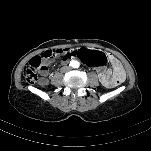 Abdominal aortic aneurysm (Radiopaedia 83581-98689 Axial C+ arterial phase 73).jpg