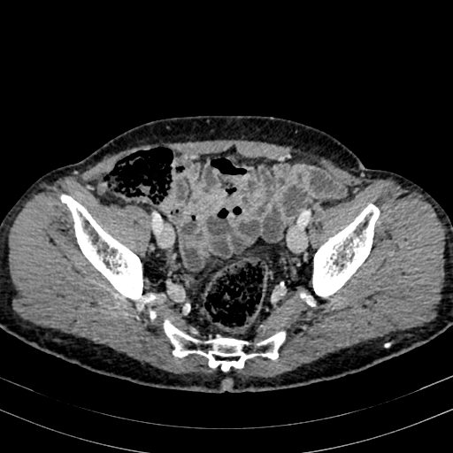 File:Abdominal aortic aneurysm (Radiopaedia 83581-98689 Axial C+ portal venous phase 94).jpg