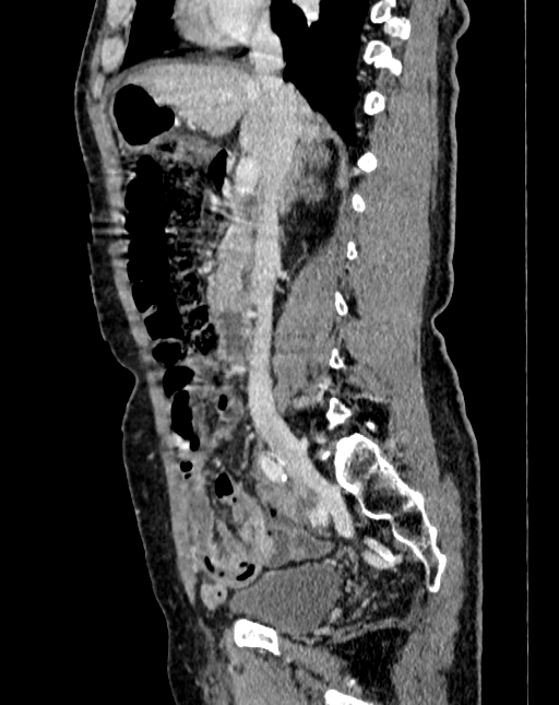 Abdominal aortic aneurysm (Radiopaedia 83581-98689 Sagittal C+ portal venous phase 26).jpg