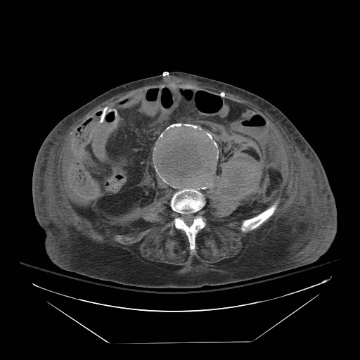 Abdominal aortic aneurysm - impending rupture (Radiopaedia 19233-19247 Axial non-contrast 102).jpg