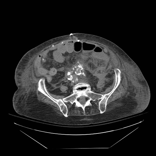 Abdominal aortic aneurysm - impending rupture (Radiopaedia 19233-19247 Axial non-contrast 117).jpg