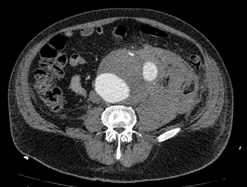 Abdominal aortic aneurysm rupture (Radiopaedia 54179-60362 Axial C+ portal venous phase 15).jpg
