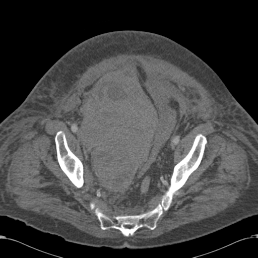 Abdominal hematoma (Radiopaedia 33614-34715 Axial C+ portal venous phase 111).png