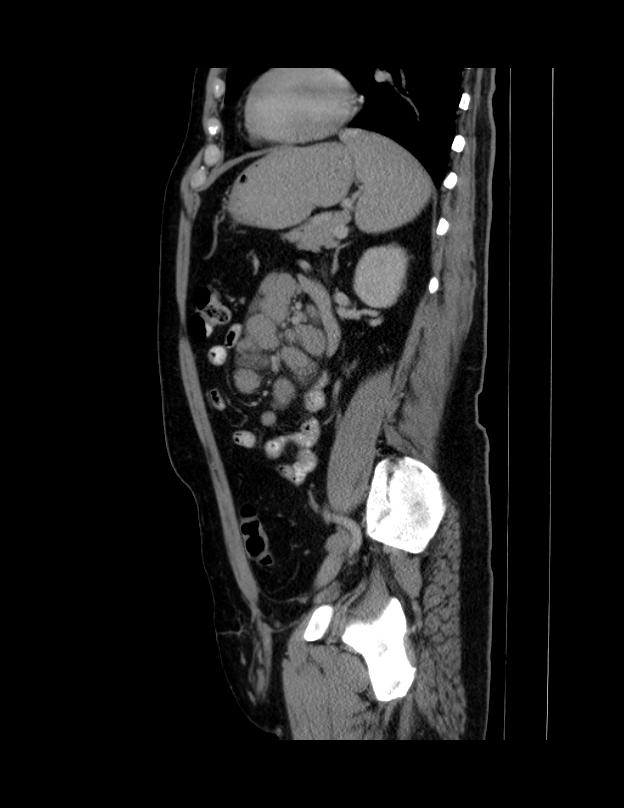 Abdominal lymphoma - with sandwich sign (Radiopaedia 53486-59492 Sagittal C+ portal venous phase 26).jpg