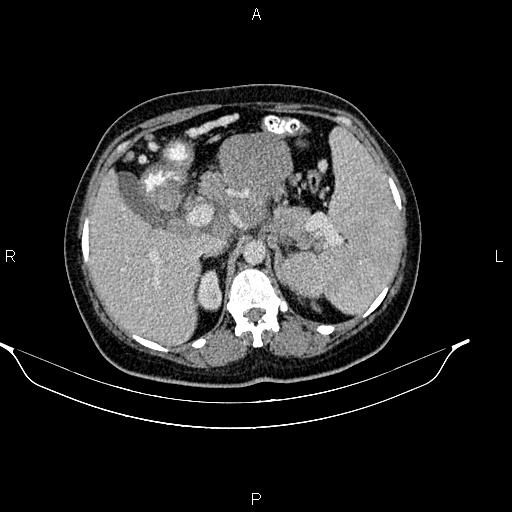 Abdominal lymphoma with sandwich sign (Radiopaedia 84378-99704 Axial C+ portal venous phase 17).jpg